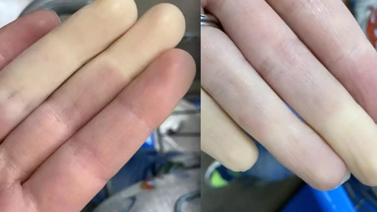 Read more about the article Q&A – How AEQ views Raynaud’s syndrome (English subs)