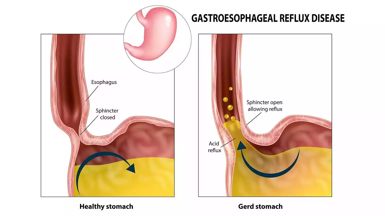 Read more about the article Q&A – AEQ’s take on the possible causes of chronic GERB (English subs)
