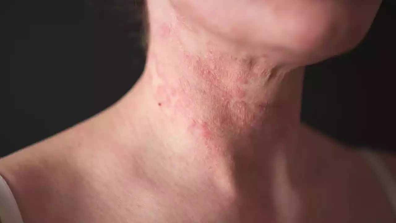 Read more about the article Q&A – The AEQ method and neurodermatitis (English subs)